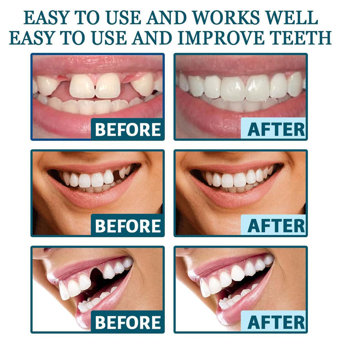 Clip on Veneers Silicone Kit for Both Upper and Lower (3Set) O4052